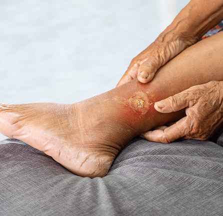 Diabetic Leg Wounds@1x