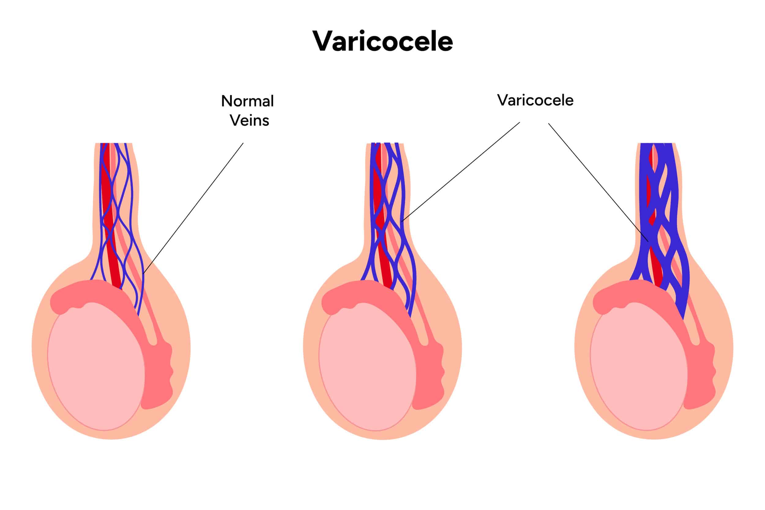 Varicocele Embolization varicocele embolization